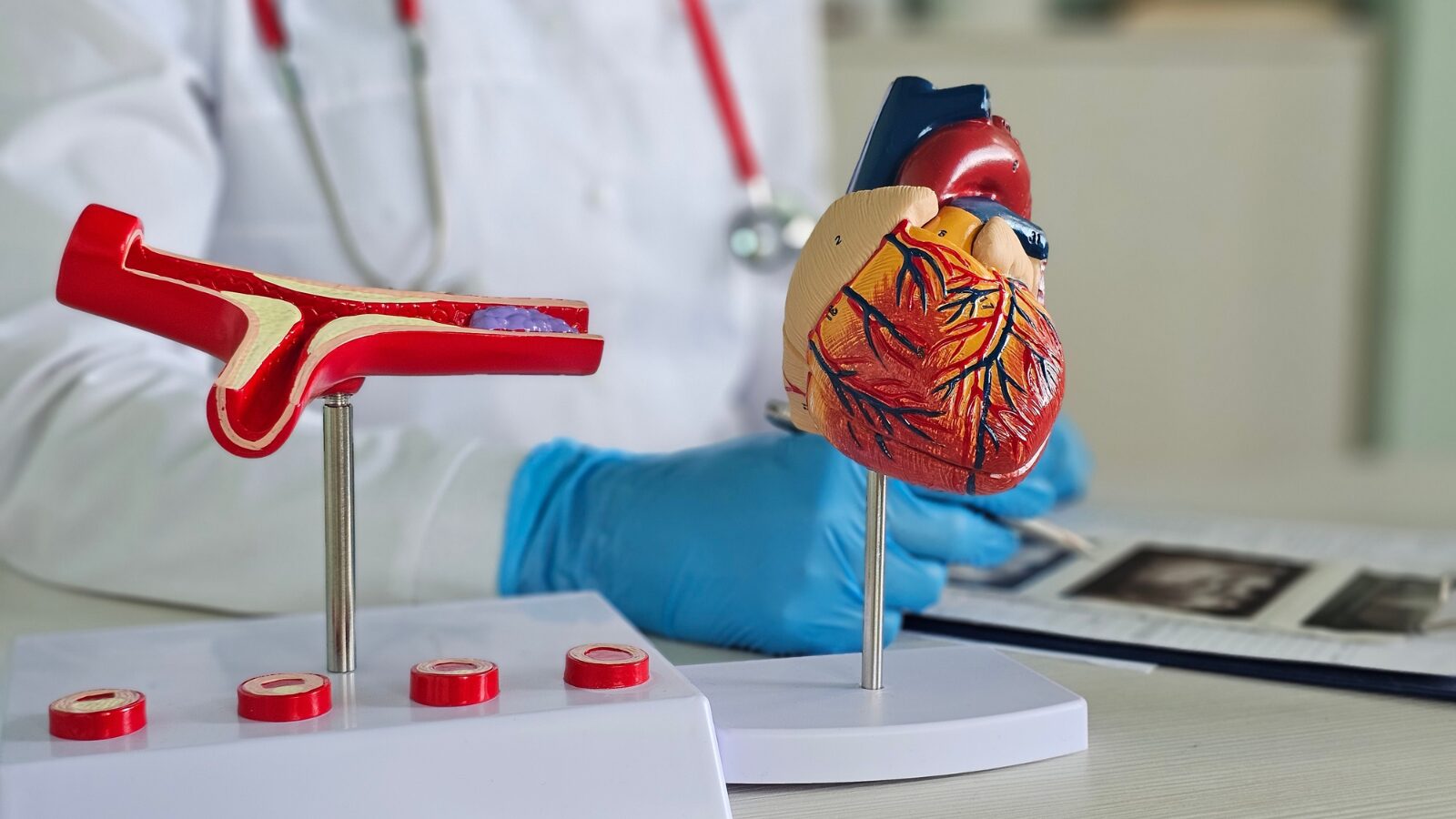 Carotid Artery Disease Carotid Artery Disease